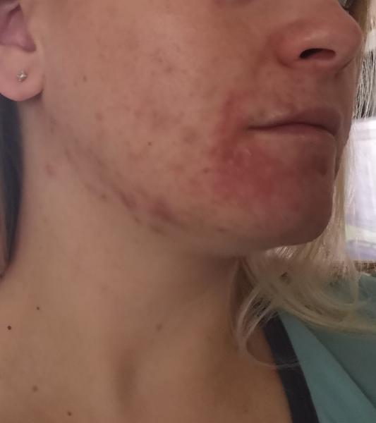 Ku koncu tehotenstva sa mi zhoršilo akné a urobila sa mi lišaj. Čo mi odporúčate?