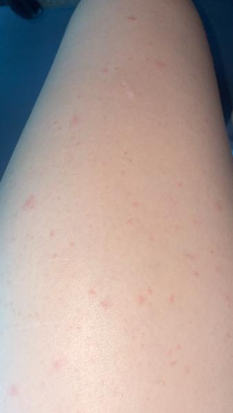 Z čoho môžu vznikať zapálené vyrážky na stehnách?