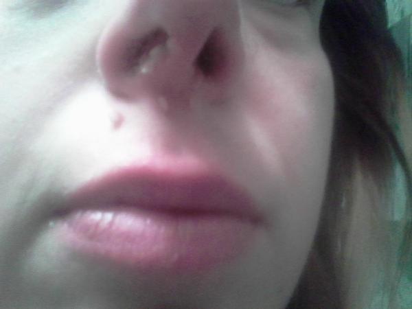 Ako sa zbaviť bradavičiek pod nosom a v nose?