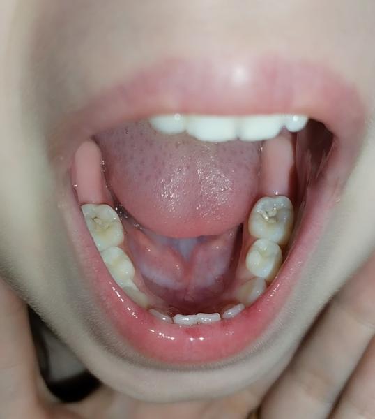 Je to kaz alebo hlboké ryhy na zuboch?