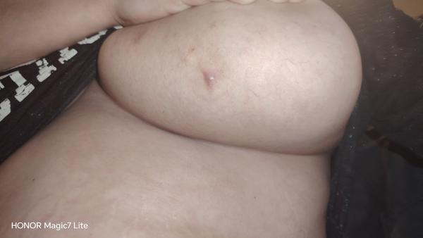 Hrčka na prsníku: Čo to môže byť?