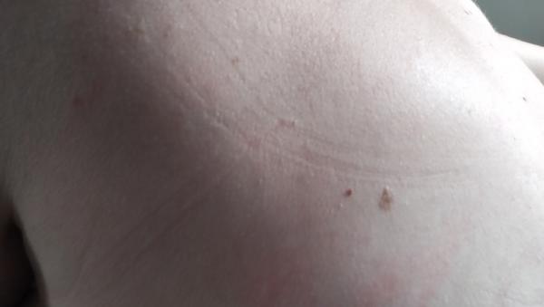 Je bledé znamienko pod prsiami normálne?