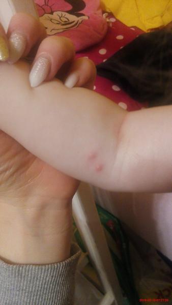 Vyrážky u štvormesačného dieťaťa