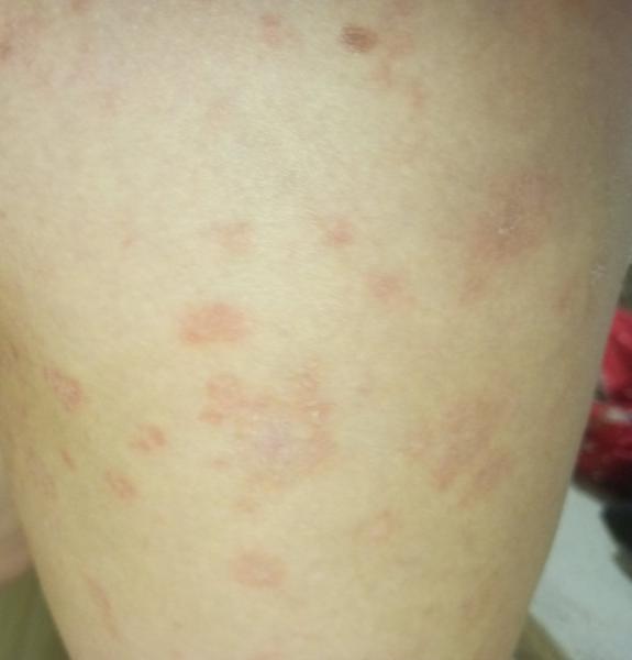 Suché fľaky na stehnách: Ako ich odstrániť?