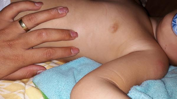 Ako liečiť znamienka, v ktorých chýba pigment?