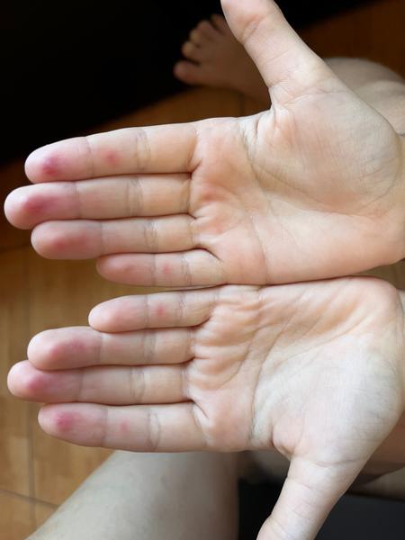 Má syn chorobu ruky - nohy - ústa?