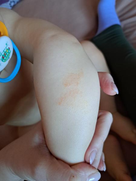 Z čoho sa môjmu synovi tvoria takéto vyrážky?