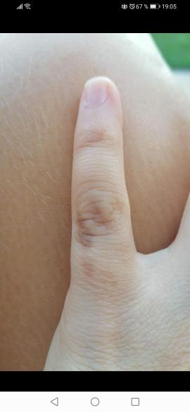 Aké tmavohnedé fľaky sa mi robia na prstoch?