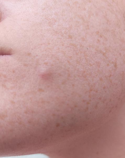 Čo robiť s podkožným zápalom na pleti?