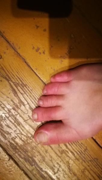 Tripím zapálenými a boľavými prstami na nohách - chilblains