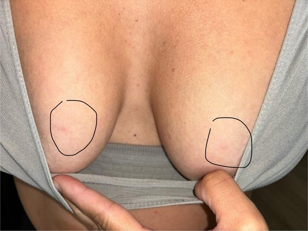 Modrina na prsníku: Može byť z podprsenky?