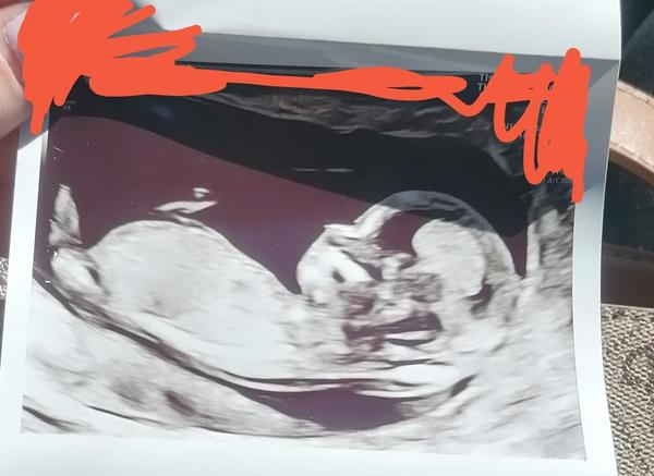 Určenie pohlavia v 14. týždni tehotenstva