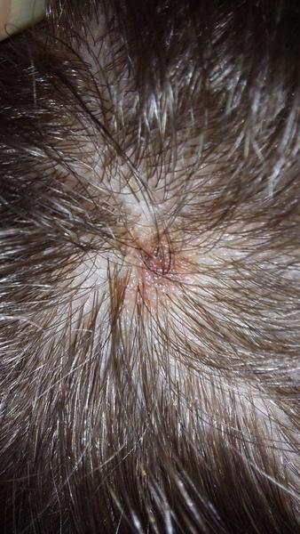 Čo spôsobilo vyrážku na hlave dievčatka?