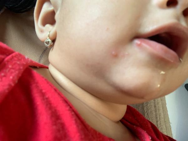 Vyrážky pri pere dieťaťa: Kedy navštíviť lekára?