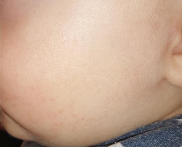 Vyrážky na líčkach malého dieťaťa.