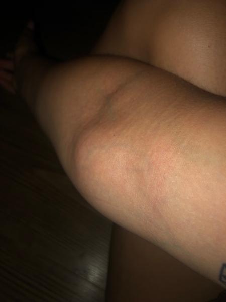 Mám ísť k lekárke, keď mám nebolestivý opuch v lakťovej jamke?