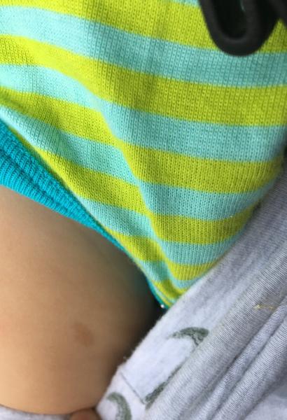 Budú synovi pribúdať ďalšie znamienka?