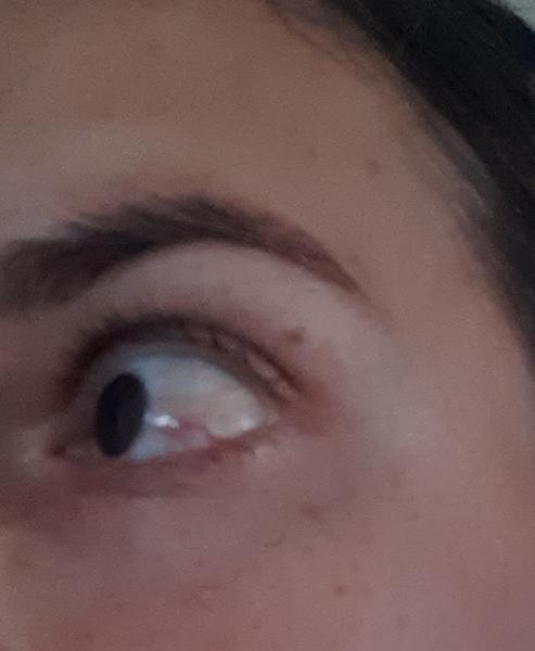 Prečo mám dlhodobo červené oko?