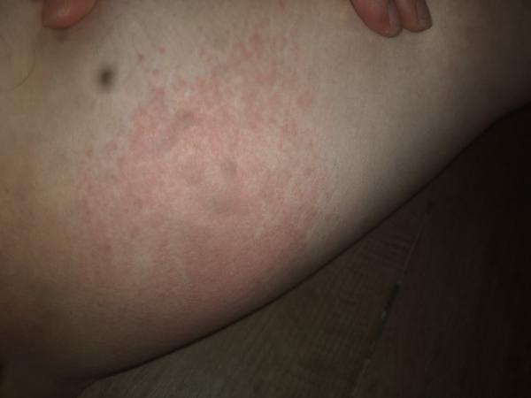 Čo znamená červená škvrna na pokožke?