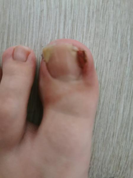 Ako sa zbaviť divého mäsa na prste?