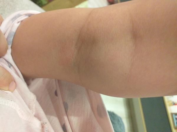 Fľaky u štvorročnej dcéry