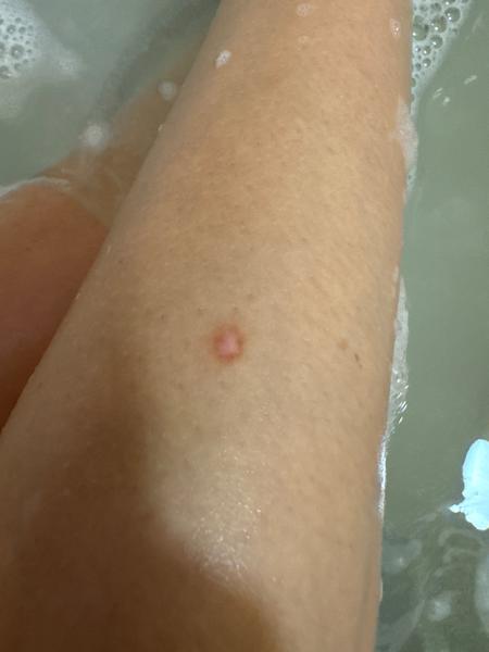 Čo spôsobuje vyrážku?