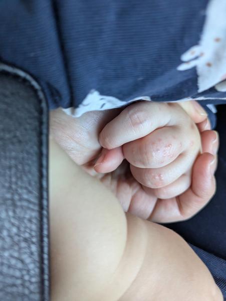 Vyrážka na prstoch po očkovaní: čo robiť?