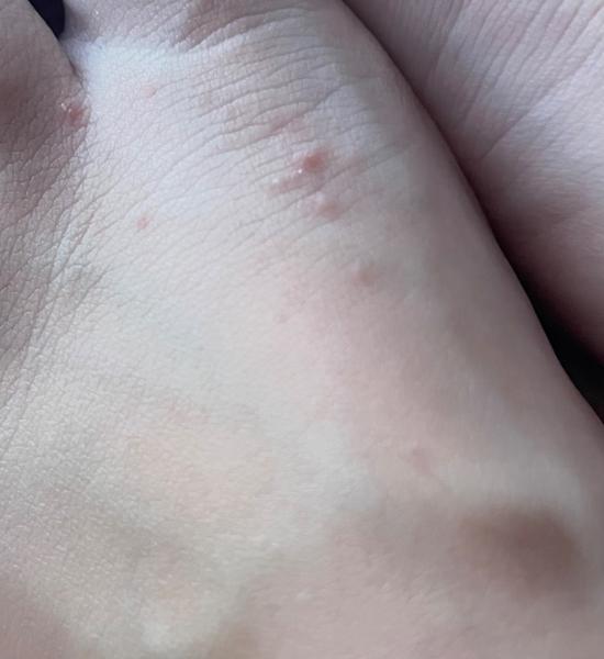 Svrbenie tela a vyrážky