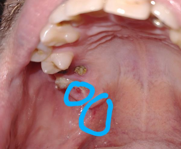 Sú červené fľaky na ďasne predzvesťou vážnejšieho ochorenia?