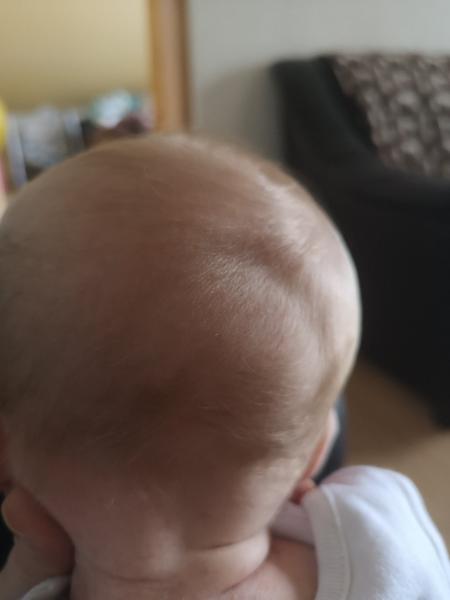 Mesačná dcérka má vzadu na hlavičke priehlbinku