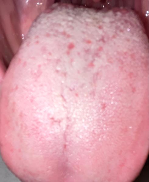 Je biely povlak na jazyku normálny?