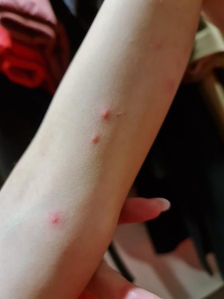 Vyrážky u 8-ročného na bedrách, stehnách, zadočku, na spodnej strane ramien