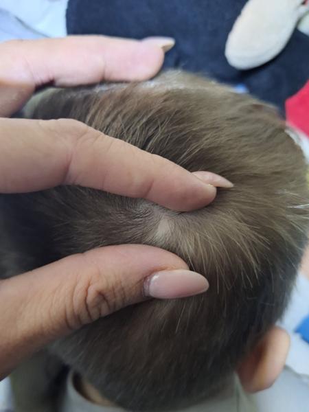 Čo znamená plešina u dvojročného dieťaťa?