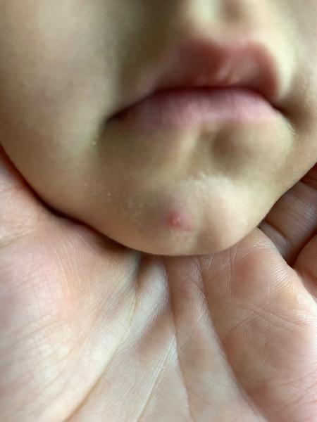 Prečo štvorročnej dcérke vzniká opakujúca sa zahnisaná vyrážka na brade?