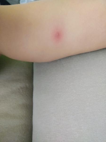 Červené bodky na nohách. Čo to môže byť?