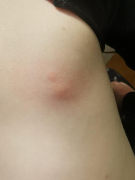 Sú to naozaj štípance od ploštice?