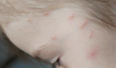 Môže mať očkované dieťa slabý priebeh kiahní?