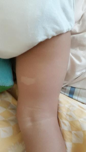 Ako liečiť znamienka, v ktorých chýba pigment?