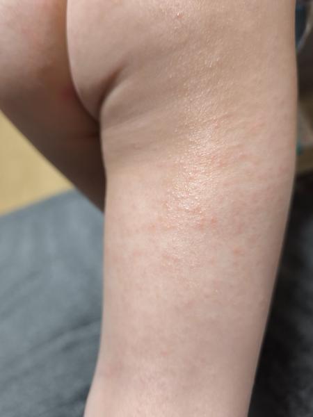 Je to ekzém alebo vírusová reakcia?