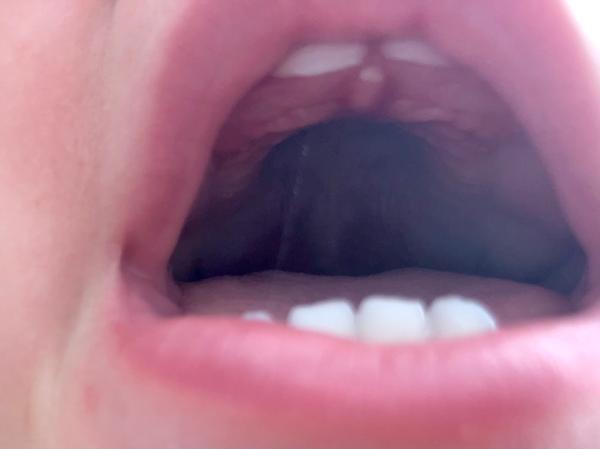 Čo rastie 1,5 ročnému synovi za prednými zúbkami?