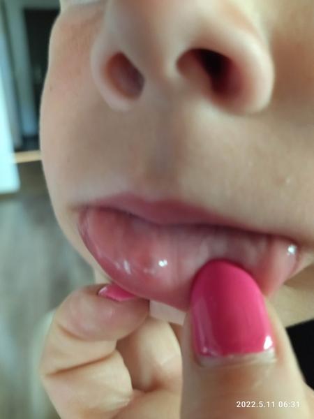 Hrčka na vnútornej strane pery