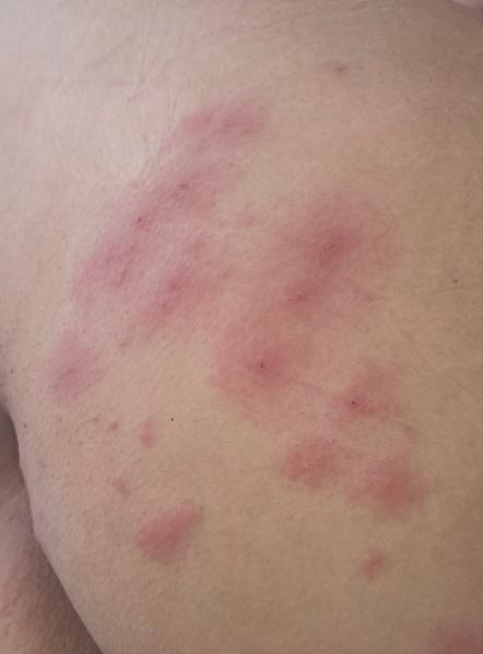 Aké sú to štípance? Pomôžte identifikovať príčinu!