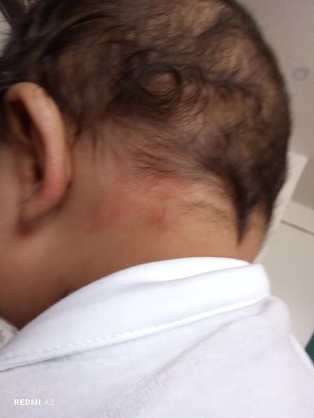 Čo spôsobuje začervenanie na krku a tvári dieťaťa?