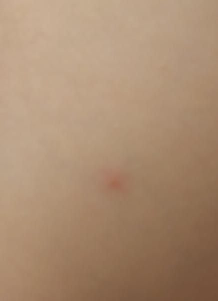 Má môj synček začínajúce kiahne?