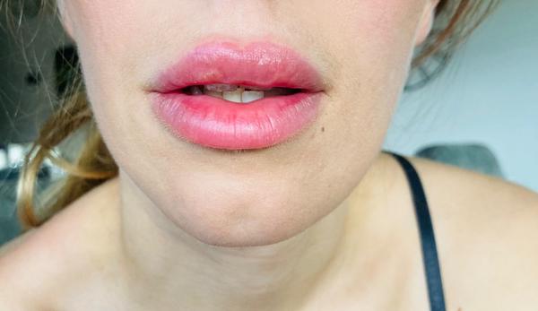 Dajú sa opraviť nerovnomerne zväčšené pery?