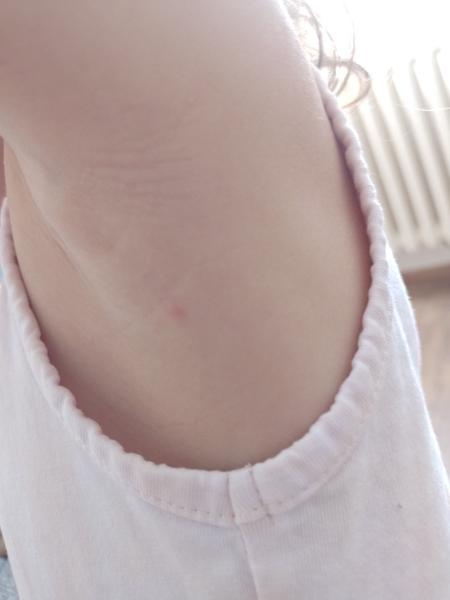 Červený fľak po kliešťovi u trojročného dieťaťa