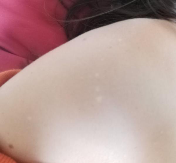 Biele škvrny na tele