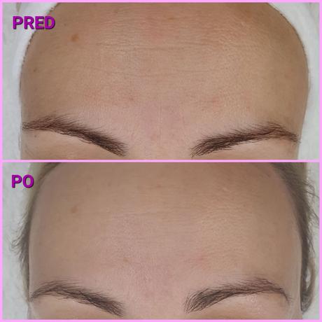 Radiothermolifting - omladenie rádiofrekvenciou, 