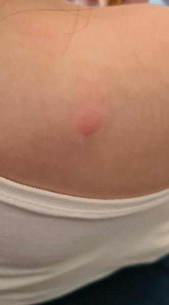 Od čoho má dieťa vyrážku?