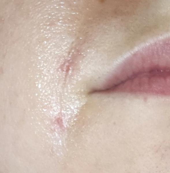 Seborea pri ústach: Ako sa liečiť?